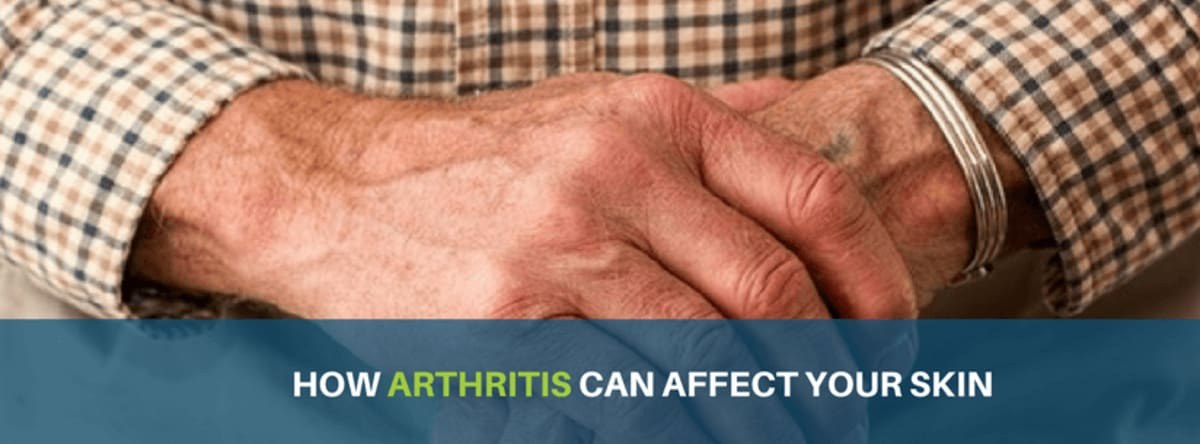 Does Arthritis Affect Your Skin? Psoriatic Plaques, Nodules & Medication Rashes