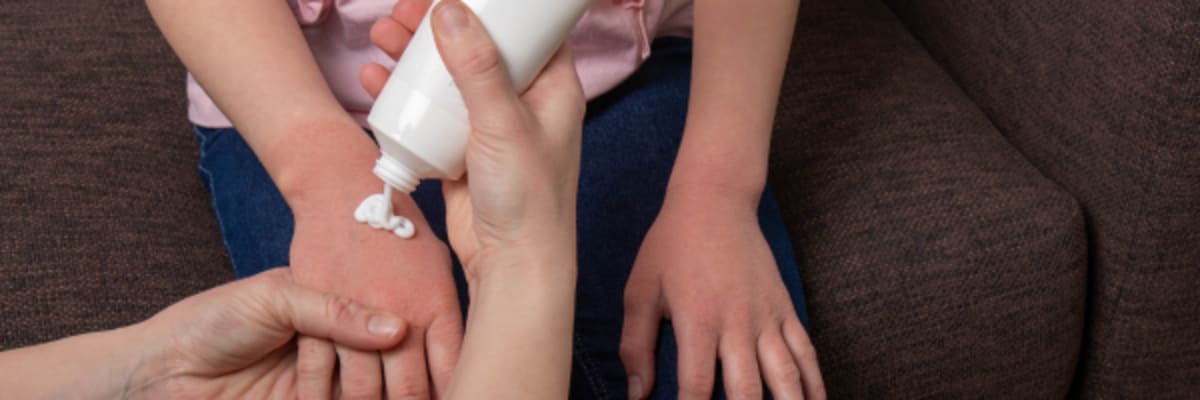 Eczema vs. Psoriasis: How Topical Corticosteroid Creams Calm Chronic Flares