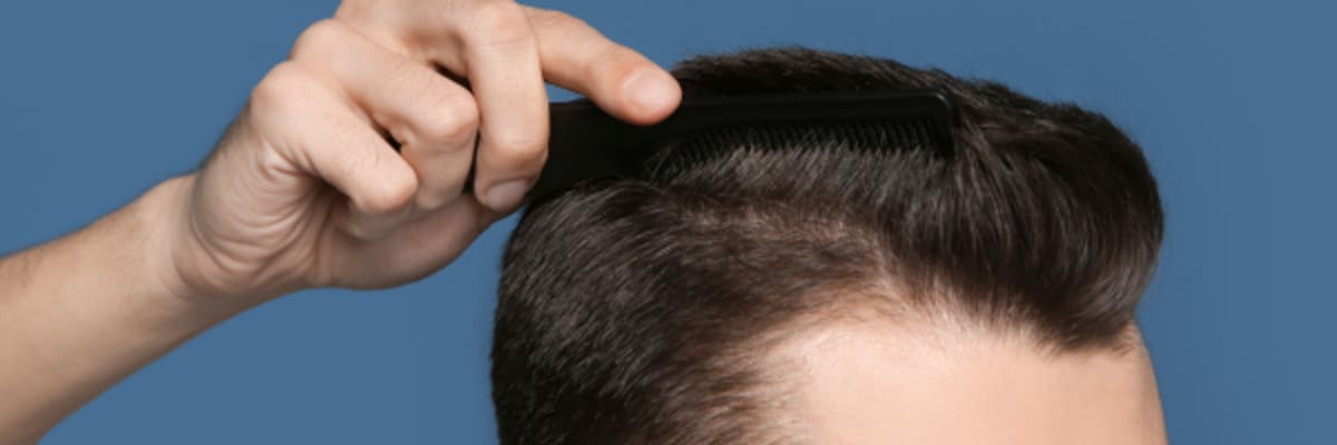 Finasteride Alternatives Compared: Minoxidil, Topical Finasteride, Dutasteride & Natural Options