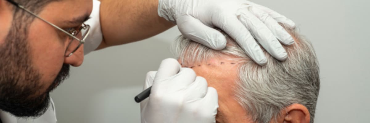 Should You Use Finasteride After a Hair Transplant? Preventing 'Inverse Balding'