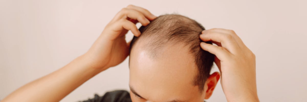 What Is Finasteride and How Does It Work for Hair Loss?