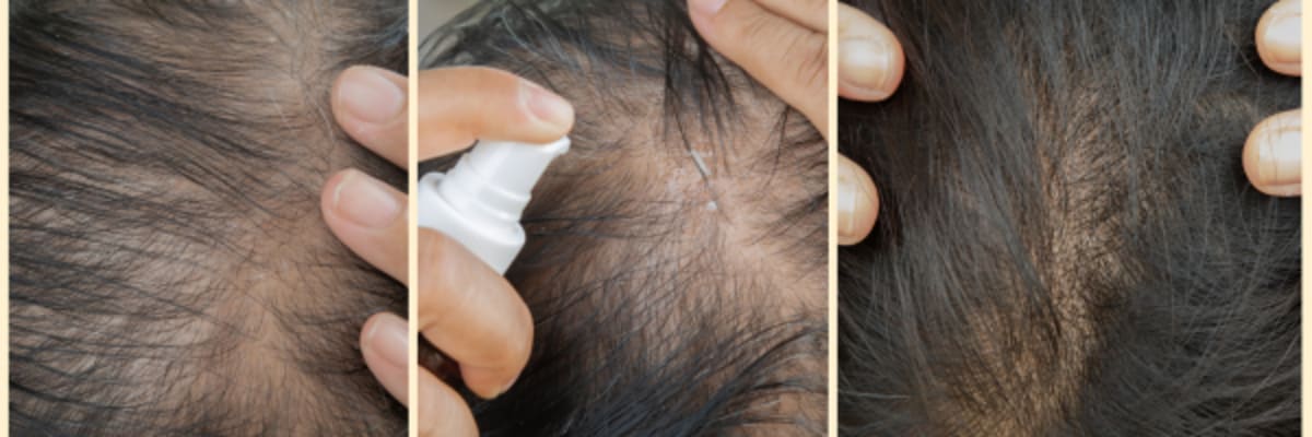 What Is the Best Hair Loss Treatment? Comparing Oral, Topical, and Combination Options